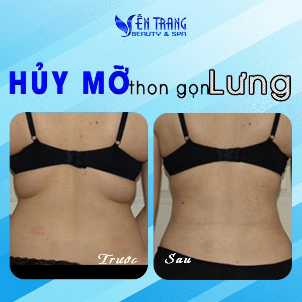 23 Hủy mỡ thon gọn lưng