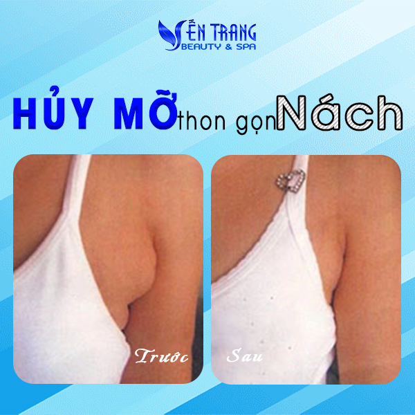 23 Hủy mỡ thon gọn nách