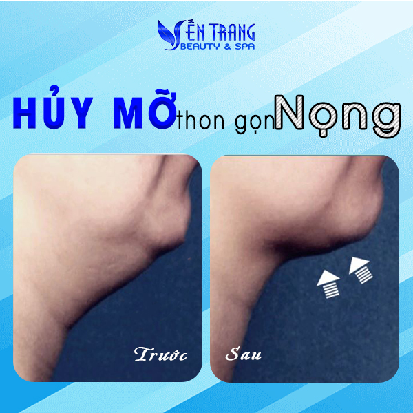 23 Hủy mỡ thon gọn nọng