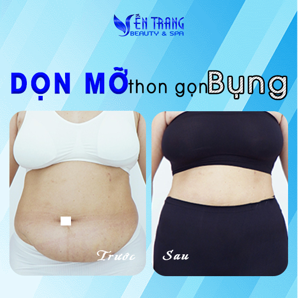 24 Dọn mỡ thon gọn bụng