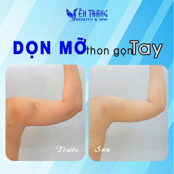 24 Dọn mỡ thon gọn tay