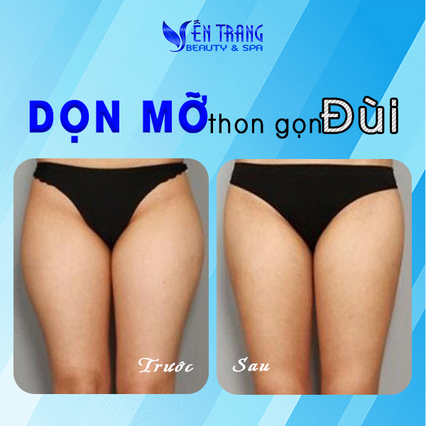 24 Dọn mỡ thon gọn đùi