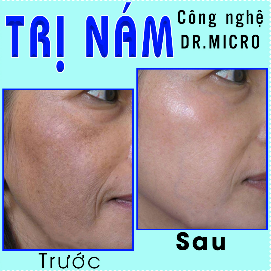 Trị nám CN Dr.Micro-trước sau