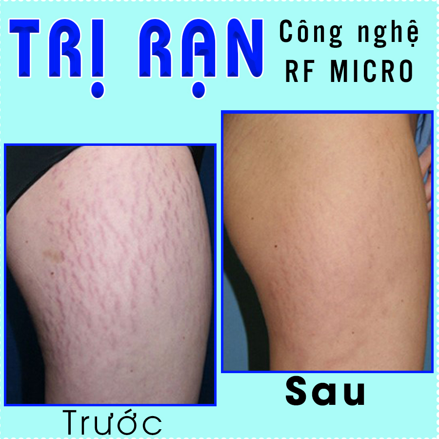 Trị rạn RFMicro-trước sau