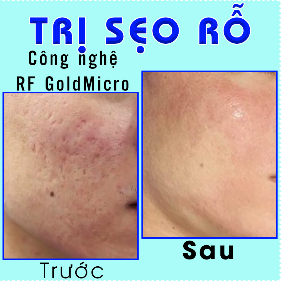 Trị sẹo rỗ CN RF GoldMicro-trước sau