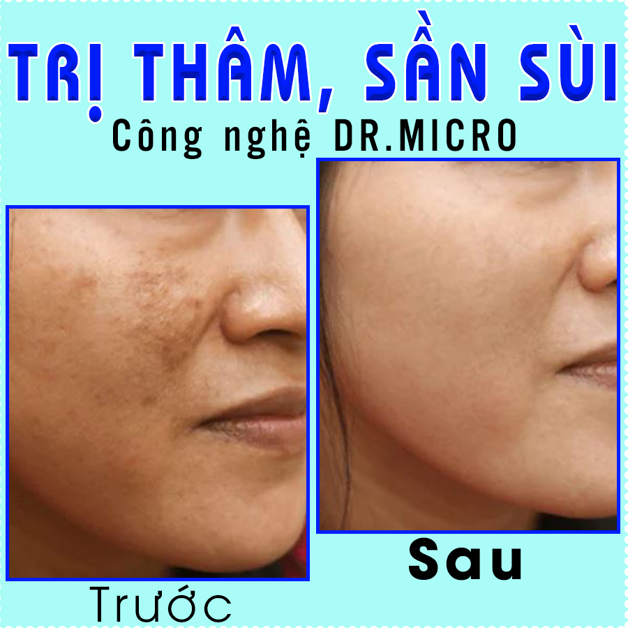 Trị thâm sần sùi Dr.Micro-trước sau